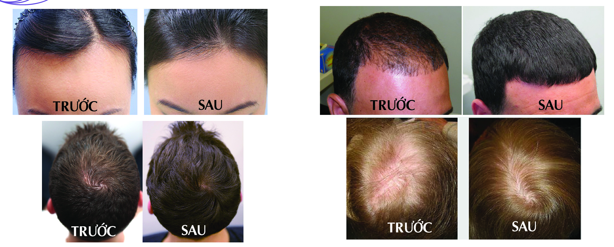điều trị rụng tóc